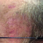 Keratosis AFTER