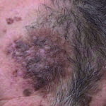 Keratosis BEFORE